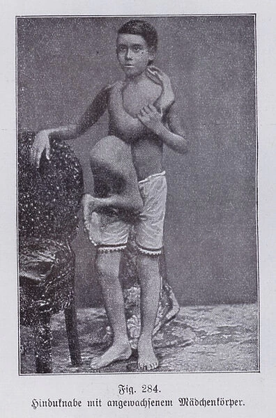 Indian boy with the conjoined body of a girl twin (b  /  w photo)