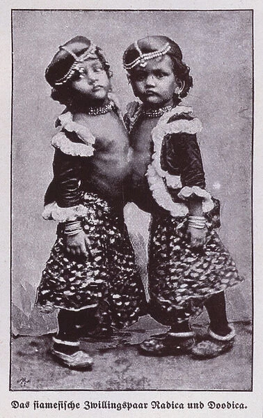 Radica and Doodica, Indian conjoined twins (b  /  w photo)