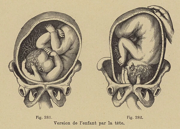 Turning a baby in its mothers womb so the head is presenting downwards before birth (engraving)