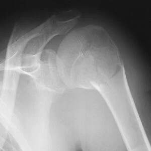 Broken shoulder, X-ray