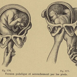Delivering a baby feet first (breech birth) (engraving)