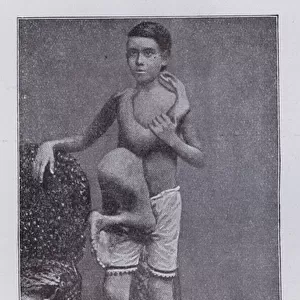 Indian boy with the conjoined body of a girl twin (b / w photo)